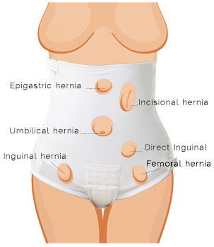 Underworks Womens Hernia Brief Item # 550 Indications and features and benefits