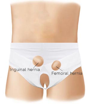 Underworks Unisex Inguinal Hernia Cotton Comfort Support Brace with Hot Cold Therapy Gel Pads - Single or Double Item # 945 Indications and features and benefits