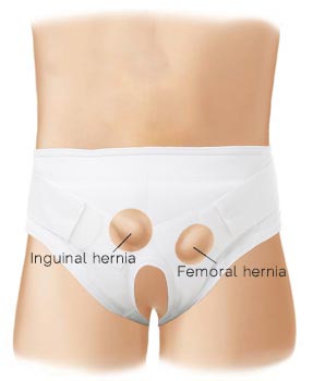Underworks Mens Inguinal Hernia Brace Item # 948 Indications and features and benefits