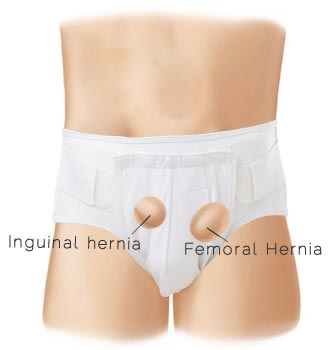 Underworks Mens Inguinal Hernia Brief Item # 953 Indications and features and benefits