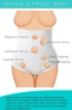 Instant relief for these types of abdominal hernias: Umbilical hernia, Low Incisional Hernia, Spigelian hernia, Direct Inguinal hernia, Inguinal hernia and Femoral hernia